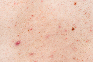 Skin background texture with pimples and blackheads. problematic skin close up. acne diseases