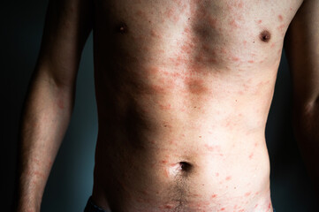 Skin imperfection. Naked man with skin allergy. Urticaria disease. Red spots on the skin. Close-up.