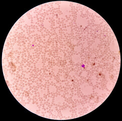 Microscopic view of hematological stained slide. thrombocytopenia