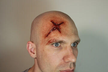 Male with Head wound #1