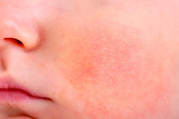 Skin allergy on the cheek of a newborn baby, macro photo. Diathesis on the face of Infante child, close-up