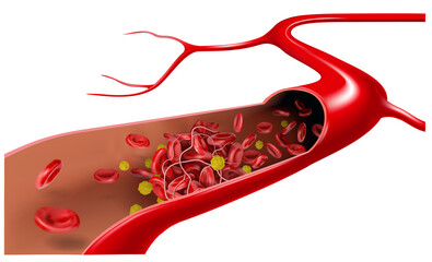 In the vein, cholesterol flows with erythrocytes and form a blood clot. 3d illustration