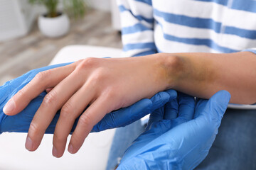 Doctor checking woman's wrist with bruise at hospital, closeup
