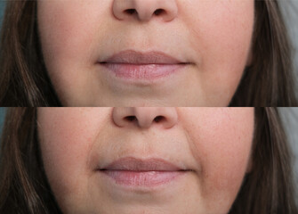 close-up of part of face of middle-aged woman in two versions, small wrinkles on skin, around lips,...
