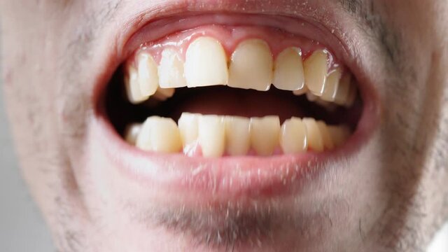 Close-up. The man shows his crooked and yellow teeth. Dental care concept. 
