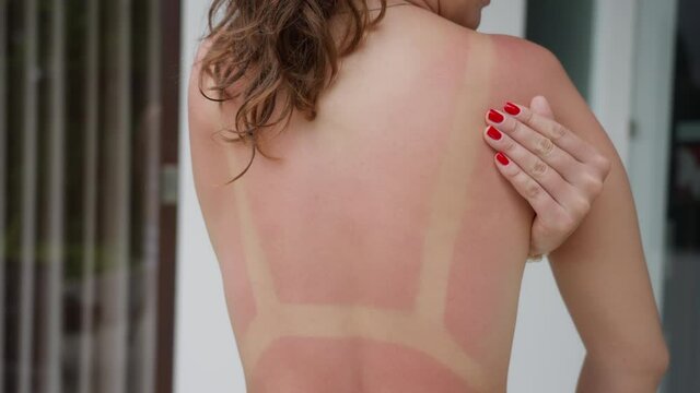 A girl with a red manicure touches her sun-burned, reddened back on the street on a sunny day. A woman touches her back, on which there is a trace of sunburn in the form of a swimsuit. Slow motion.