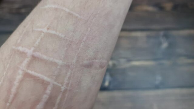The Scars on the arm. Cut marks on the arm. Hand injuries. Scars on the skin.