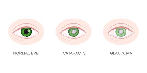 Healthy, cataract and glaucoma eye closeup view. Eyeball with normal and unhealthy lens. Aging visual problems concept. Anatomically detailed human organ of vision. Vector cartoon illustration.