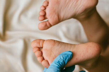 Rash of enterovirus infection picornavirus families on the feet of a 3-year-old child. Medicine,...