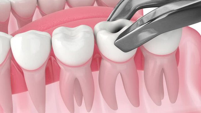 Jaw with tooth extraction, space maintainer and new tooth growth process