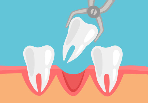 Unhealthy tooth removal process concept vector illustration. Dental extraction forceps and tooth in flat design.