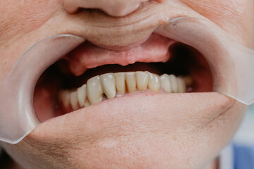 Obraz premium toothless jaw in the dental office 