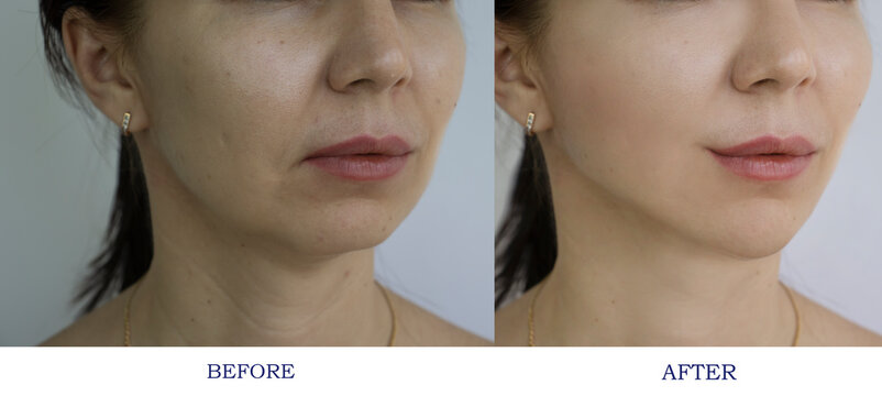 woman face wrinkles before and after treatment