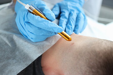 Laser removal of a mole on man neck in beauty salon