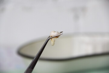 Dentist shows the extracted tooth in tweezers