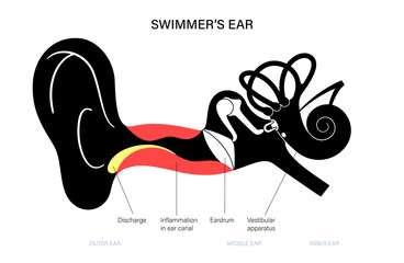 Swimmers ear otitis