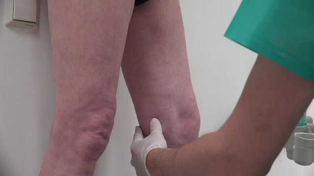 Ultrasonography of Lower Extremity Varicose Veins