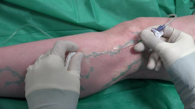 Vascular Surgeon is Marking Veins for Varicose Surgery and Analgesia.