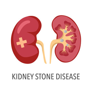 Kidney stone disease concept vector illustration on white background.
