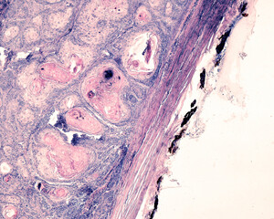 Squamous cell carcinoma of the eyeball