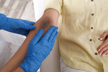 Doctor checking woman's elbow with bruise at hospital, closeup