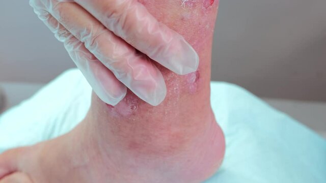 female doctor assistant examines and treats leg woman with scratches, scars, eczema, skin flayed on lower leg, wounds are bleeding, concept of medical care, scratching sores, self-harm