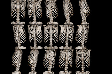 CT Scan thoracic spine 3D rendering image case trauma fracture thoracic spine .