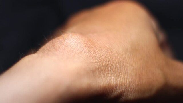 Ganglion Cyst from hard work