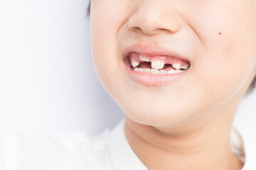Obraz premium Little boy milk tooth falls out as new ones are growing.