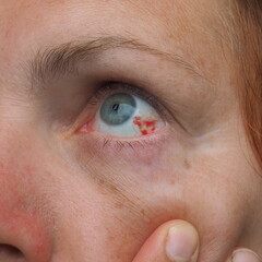 Subconjunctival hemorrhage or subconjunctival bleeding, hyposhagmus. Bleeding under the...