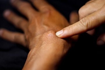 Ganglion Cyst from hard work
