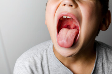 The boy's mouth is wide open with tonsils are enlarged, visible in them white or yellowish tinge on a gray background. Sore throat in children.