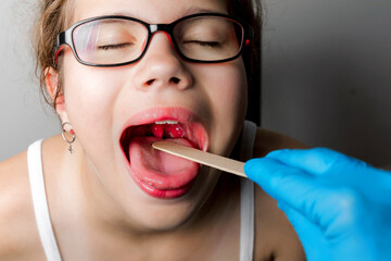 The girl's mouth is wide open with tonsils are enlarged, visible in the white or yellowish tinge on...