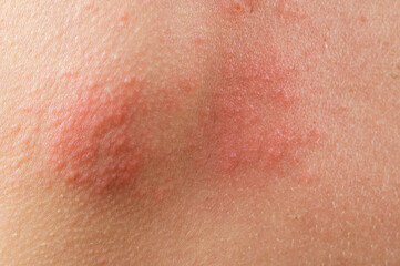 chickenpox rash. Shingles, varicella-zoster virus. skin rash and blisters on body. Skin infected Herpes zoster virus. Herpes Virus on body. urticaria rash. atopic dermatitis