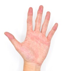 Cyanotic hands or peripheral cyanosis or blue hands at Southeast Asian, Chinese male patient