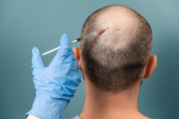 Mesotherapy. The trichologist doctor's hand makes an injection into the lesion of baldness. Back...