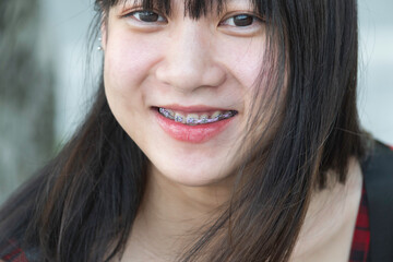 Closeup beautiful smiling girl with dental braces fashion healthy and lifestyle.