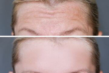 Deep mimic forehead wrinkles before and after treatment, smoothing and correction of face wrinkles...