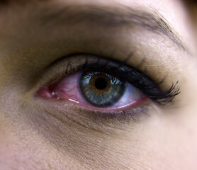 Young woman with burst blood vessel in eye, closeup image. Bloodshot eye. Woman with burst blood...