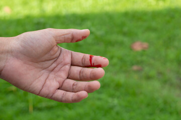 A man's hand was injured and bleeding due to accident.