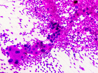 Hepatocellular dysplasia, cellular enlargement, nuclear pleomorphism, and multinucleation, light micrograph, photo under microscope 100x view