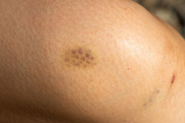 Background of bruised wound on wound woman at knee skin