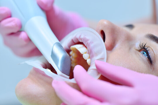 Orthodontist using 3D intraoral scanner for scanning teeth patient's.