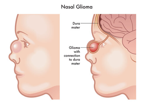Medical illustration of the symptoms of a nasal glioma on a baby, with annotations.