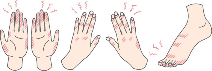 手荒れ 手足のしもやけ のイラスト