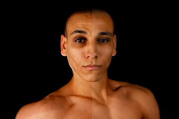 the concept of skin care before, after. young egytian man with bad skin with wrinkles and acne and...