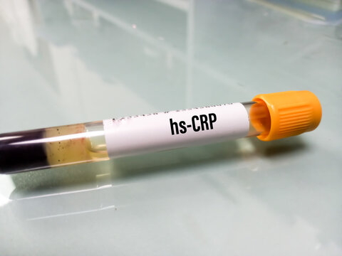 Blood sample tube for hs CRP(high-sensitivity C-reactive protein) test,  risk for heart disease and stroke Stock Photo | Adobe Stock