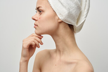 woman with a pimple on the face skin problems close-up