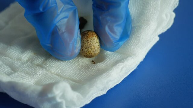 Removed gallstones on compress after gallbladder laparoscopic surgery endoscopy removing. Cholecystectomy on abdomen Liver dysfunction icteruswith bilirubin biliary tract obstruction precipitated bile