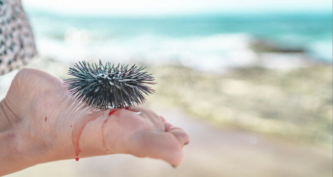 Das tut weh, der Seeigel steckt mit seinen Stacheln im Fu&szlig; und es blutet